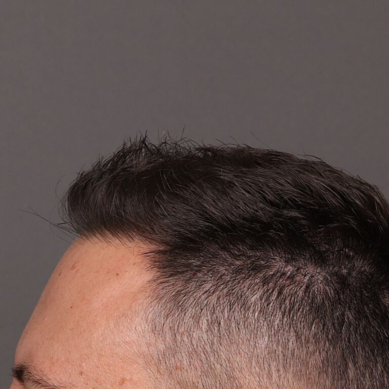After Image: FUE Hair Transplant by Dr. Manning -