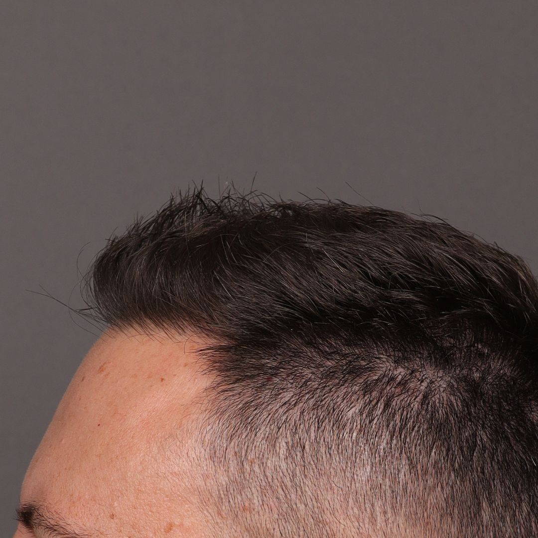 After Image: FUE Hair Transplant by Dr. Manning - 