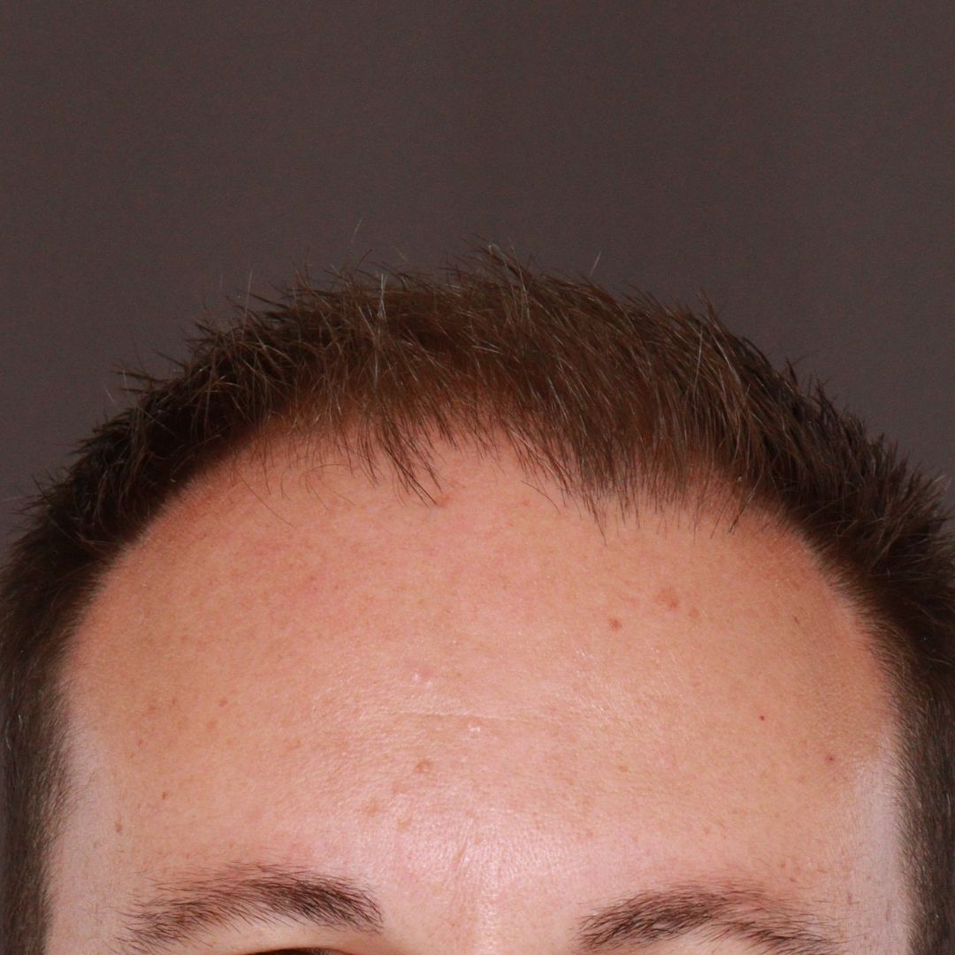 Before Image: FUE Hair Transplant by Dr. Manning - front