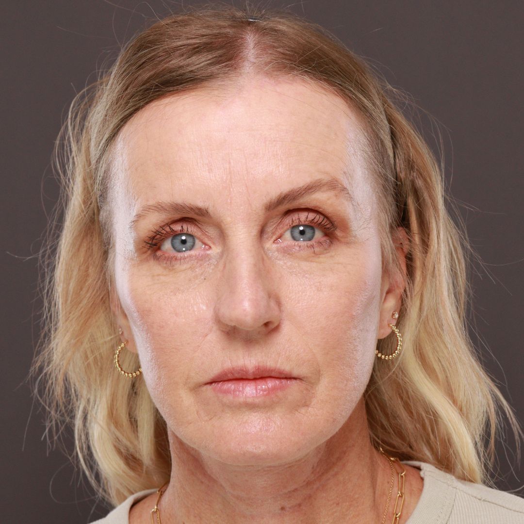 After Image: Forehead Reduction by Dr. Thompson - front