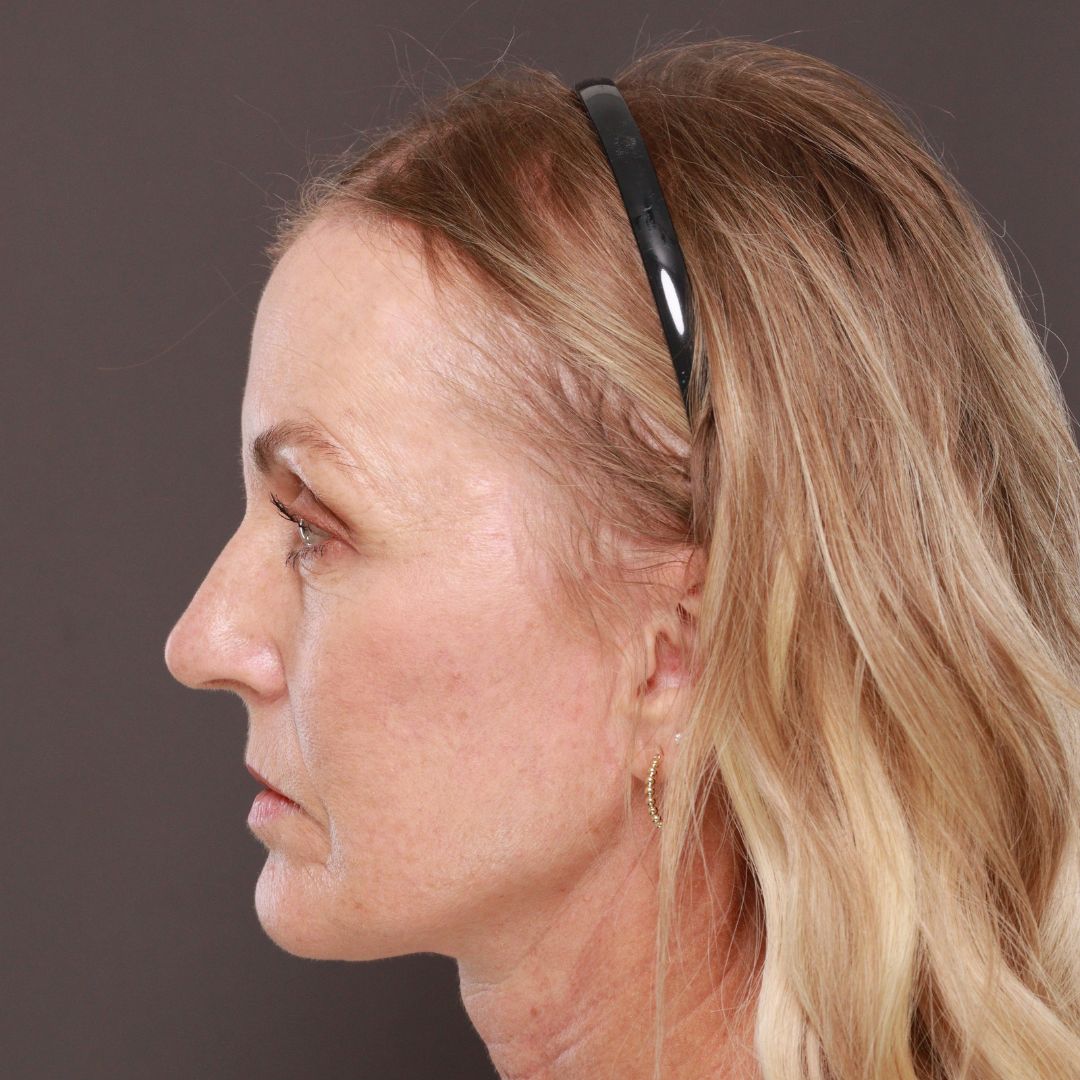 After Image: Forehead Reduction by Dr. Thompson - left-side