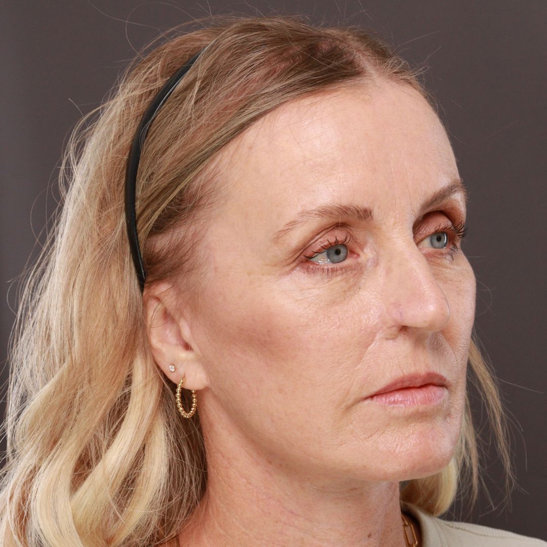 After Image: Forehead Reduction by Dr. Thompson - right-front-oblique