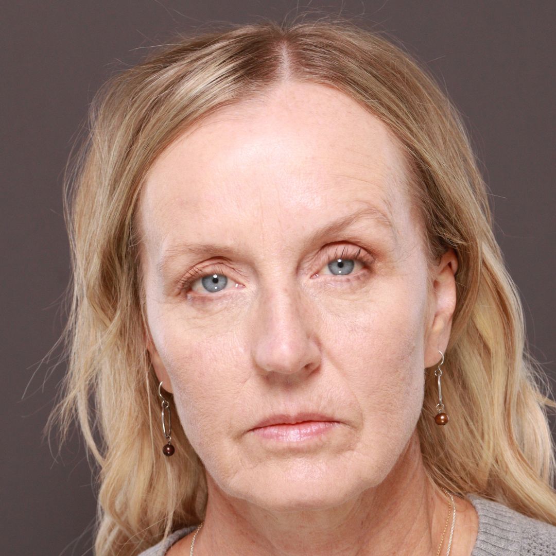 Before Image: Forehead Reduction by Dr. Thompson - front