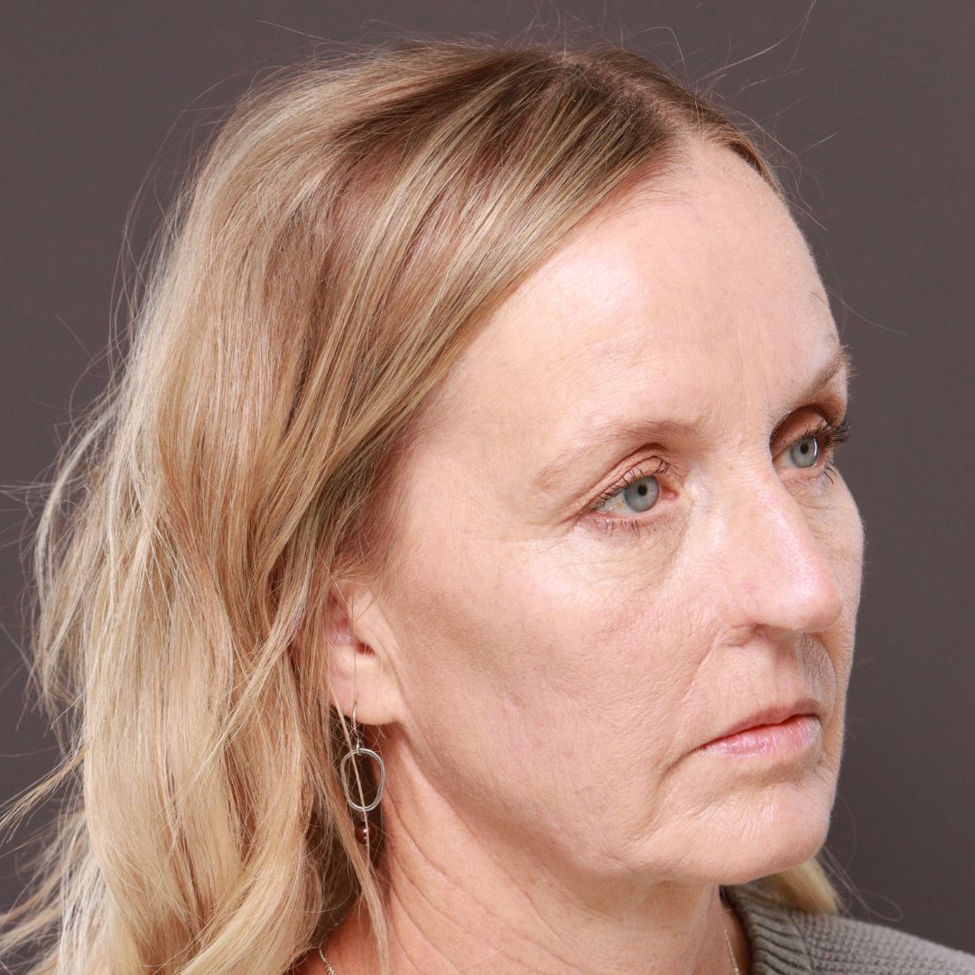 Before Image: Forehead Reduction by Dr. Thompson - right-front-oblique