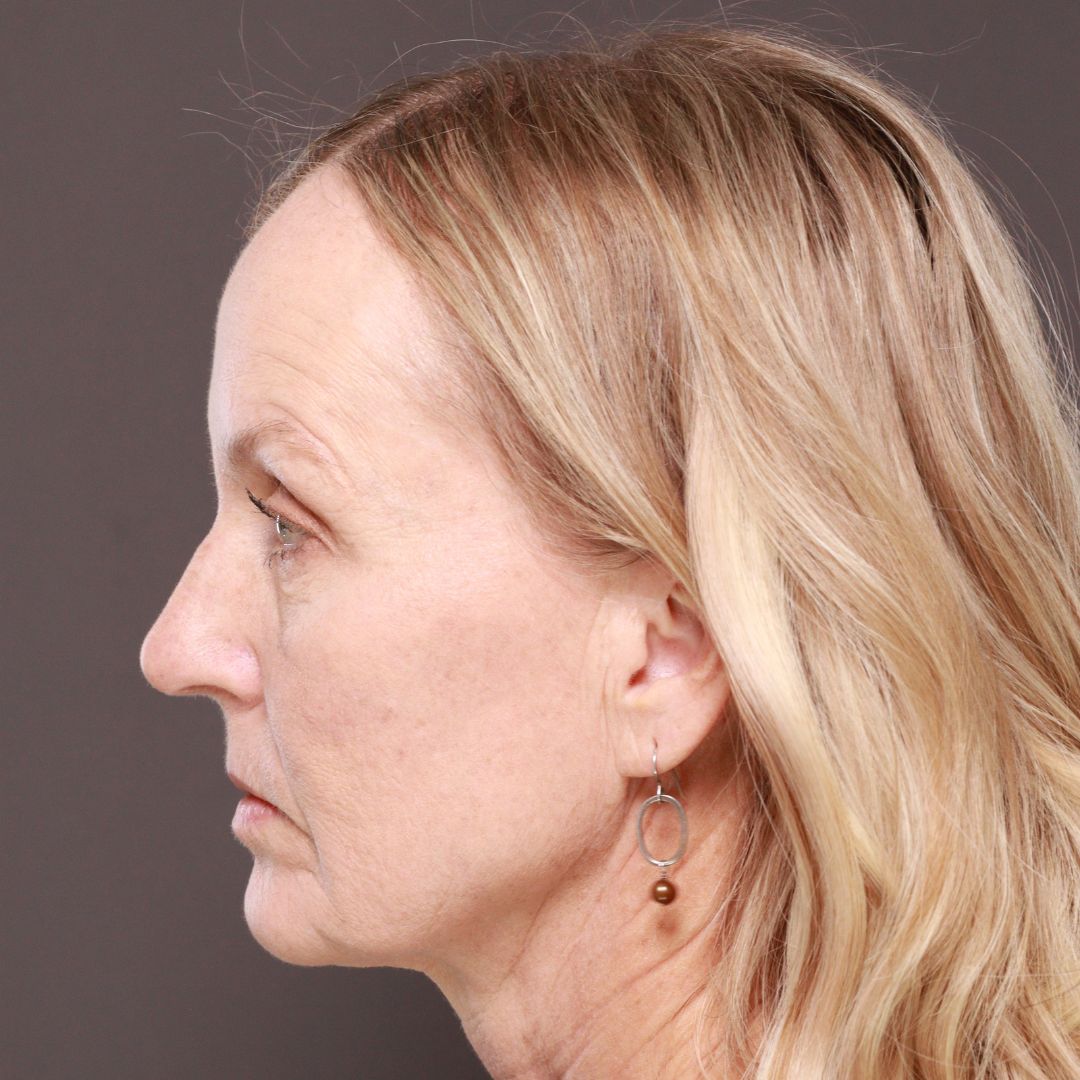 Before Image: Forehead Reduction by Dr. Thompson - left-side