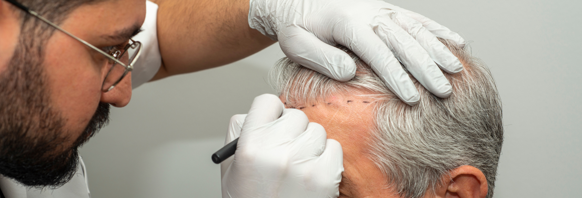 UFP Hair Restoration (12)