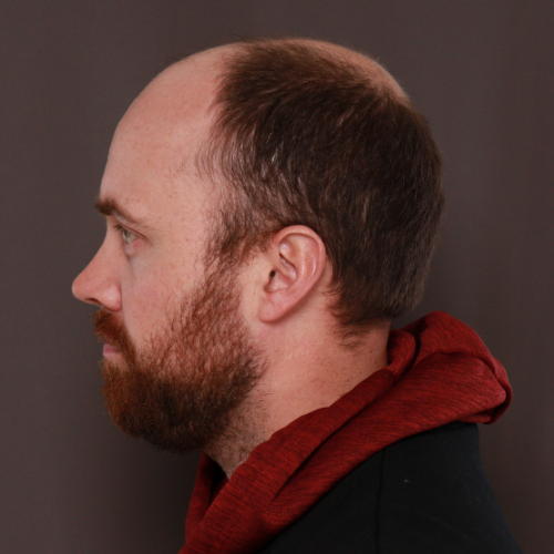 Before Image: NeoGraft Hair Transplant - left-side