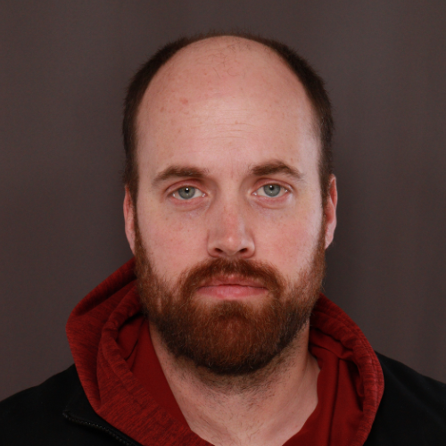 Before Image: NeoGraft Hair Transplant - front