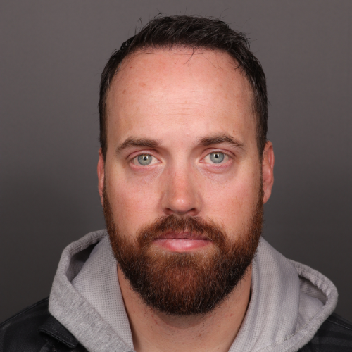 After Image: NeoGraft Hair Transplant - front