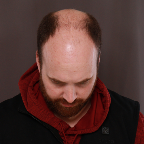 Before Image: NeoGraft Hair Transplant - front