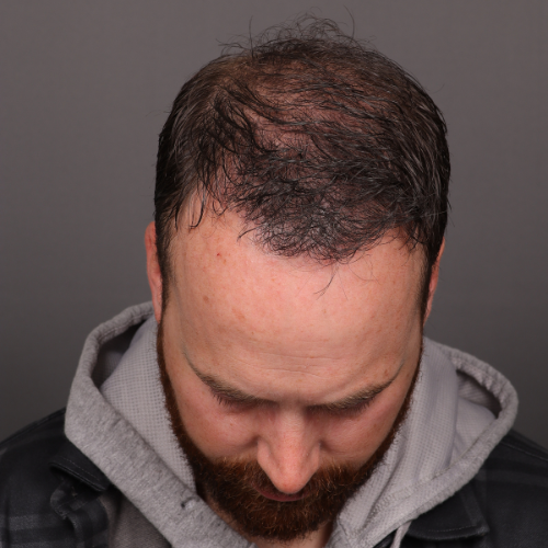 After Image: NeoGraft Hair Transplant - front