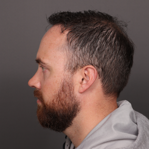 After Image: NeoGraft Hair Transplant - left-side