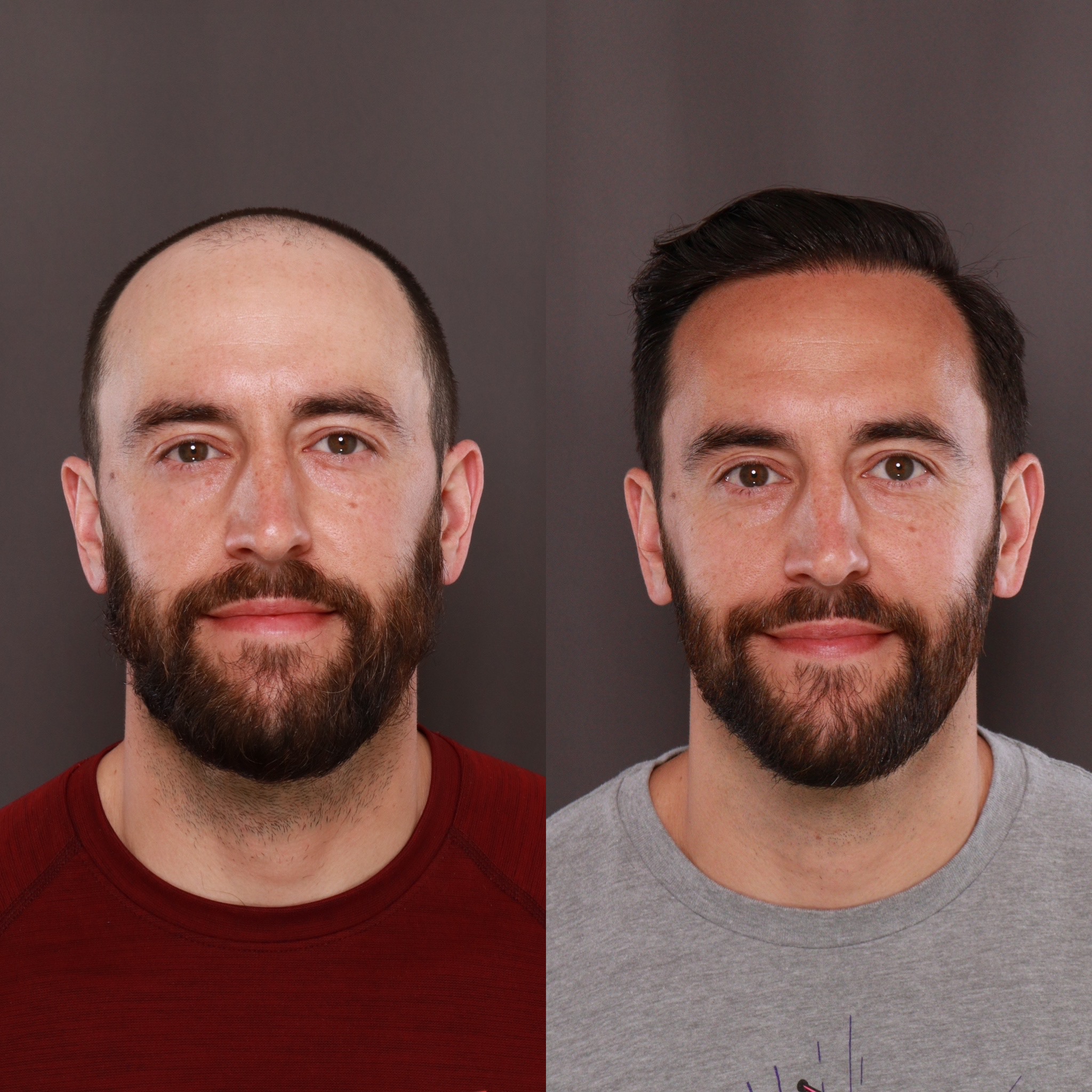 Hair Transplant at UFP Hair Restoration Before & After