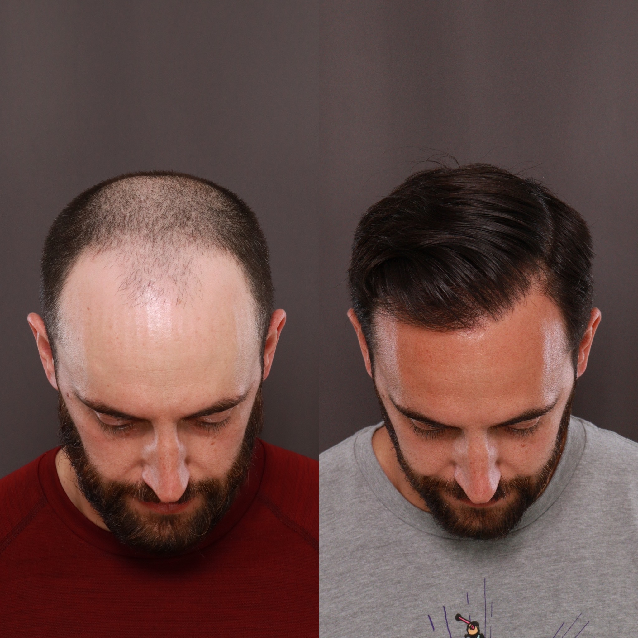Hair Transplant at UFP Hair Restoration Before & After