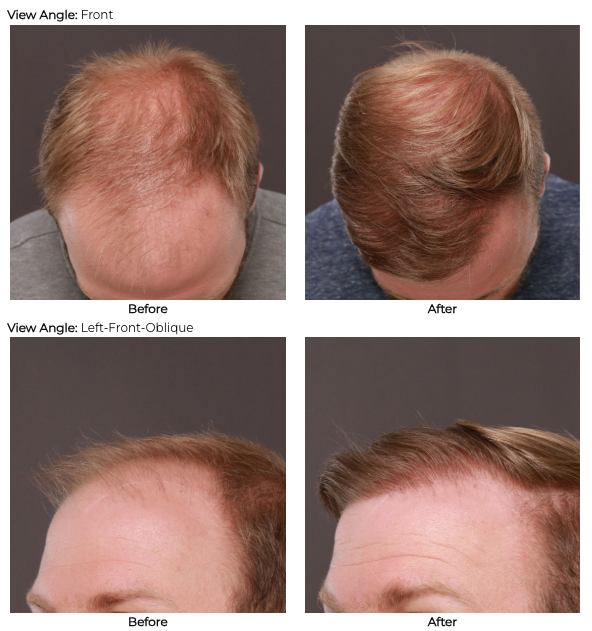 Hair Transplant at Utah Facial Plastics