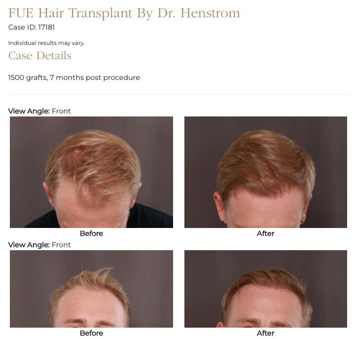 UFP Hair Restoration