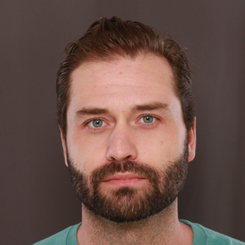 After Image: FUE NeoGraft Hair Transplant - front
