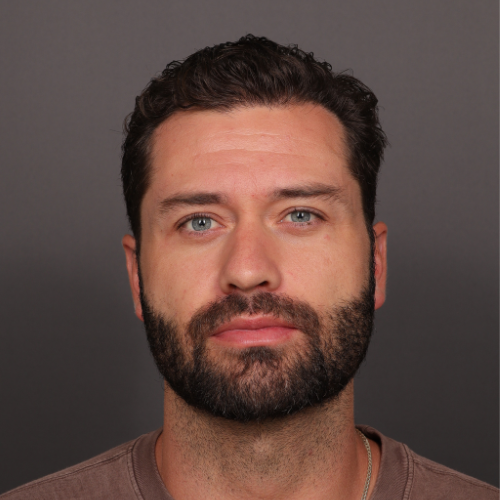 Before Image: FUE NeoGraft Hair Transplant - front