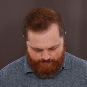 After Image: FUE & Neograft Hair Transplant Surgery