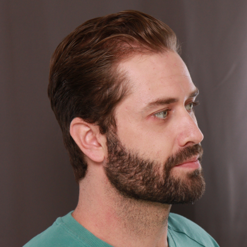 Before Image: FUE NeoGraft Hair Transplant - right-front-oblique