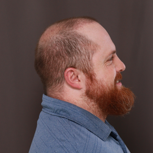 Before Image: FUE & Neograft Hair Transplant Surgery - front