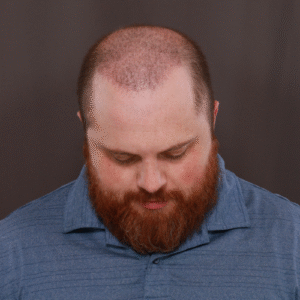 Before Image: FUE & Neograft Hair Transplant Surgery