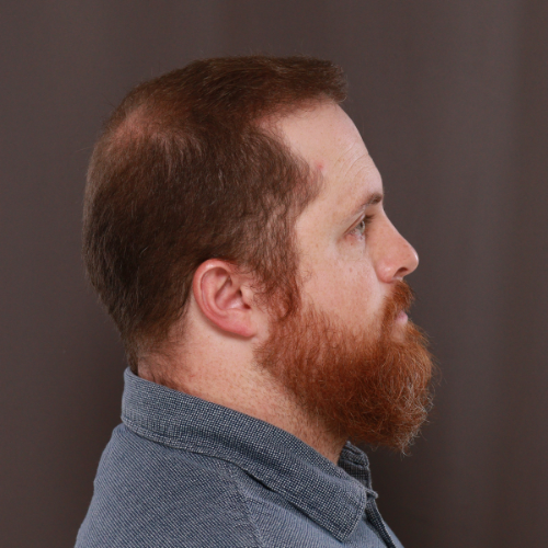 After Image: FUE & Neograft Hair Transplant Surgery - front