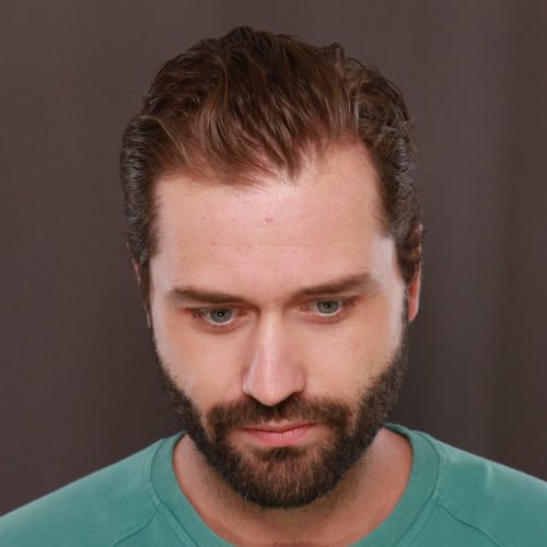 Before Image: FUE NeoGraft Hair Transplant - front