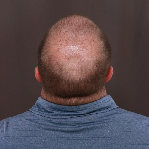 Before Image: FUE & Neograft Hair Transplant Surgery - front