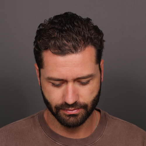 After Image: FUE NeoGraft Hair Transplant - front