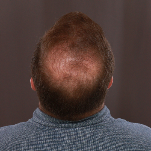 After Image: FUE & Neograft Hair Transplant Surgery - front