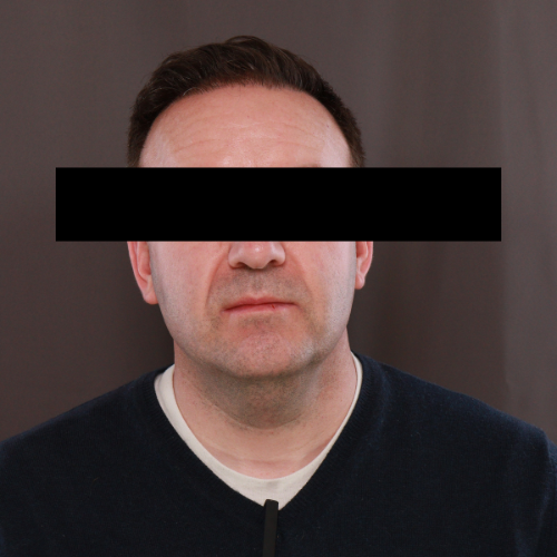 After Image: Scalp FUE & Neograft Hair Transplant - front