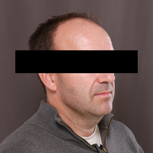 Before Image: Scalp FUE & Neograft Hair Transplant - right-front-oblique