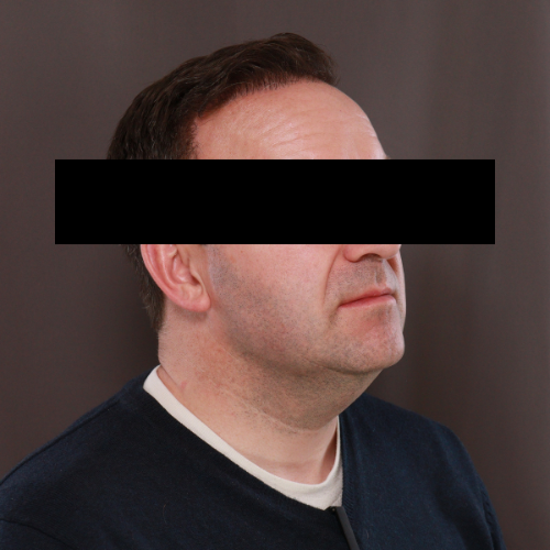 After Image: Scalp FUE & Neograft Hair Transplant - right-front-oblique
