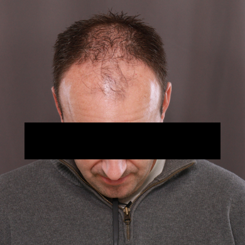 Before Image: Scalp FUE & Neograft Hair Transplant - front
