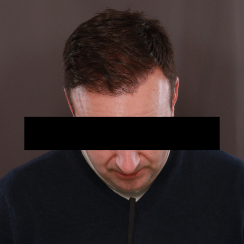After Image: Scalp FUE & Neograft Hair Transplant - front