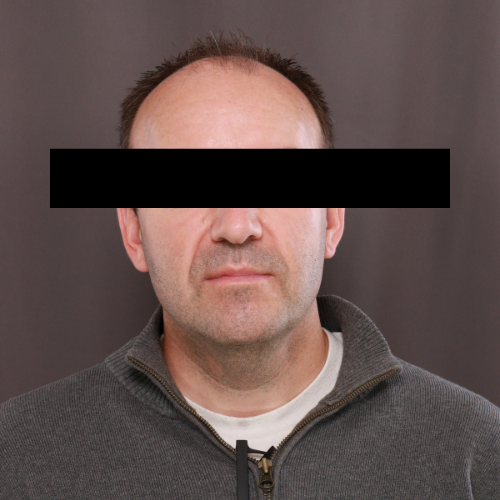 Before Image: Scalp FUE & Neograft Hair Transplant - front