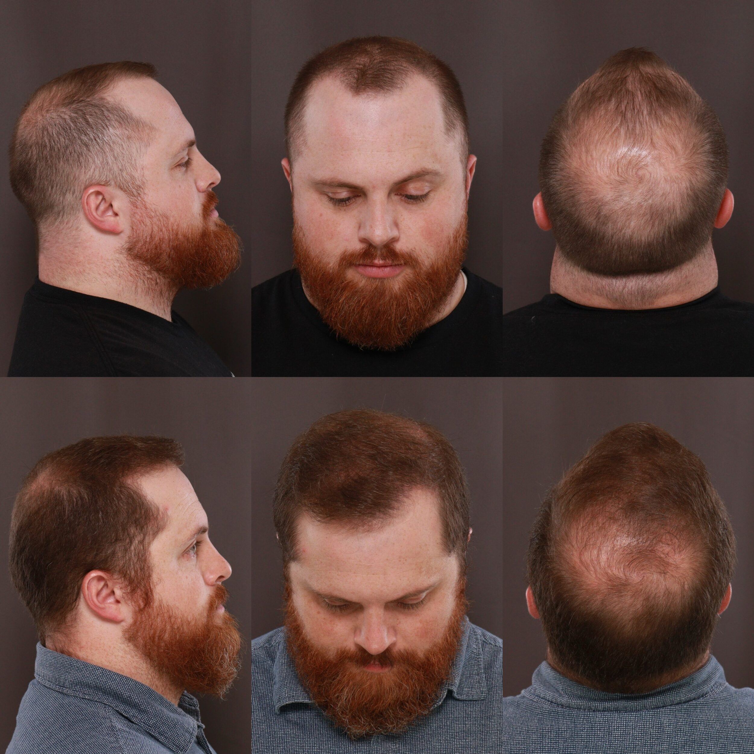 UFP Hair Restoration Salt Lake City Hair Transplant