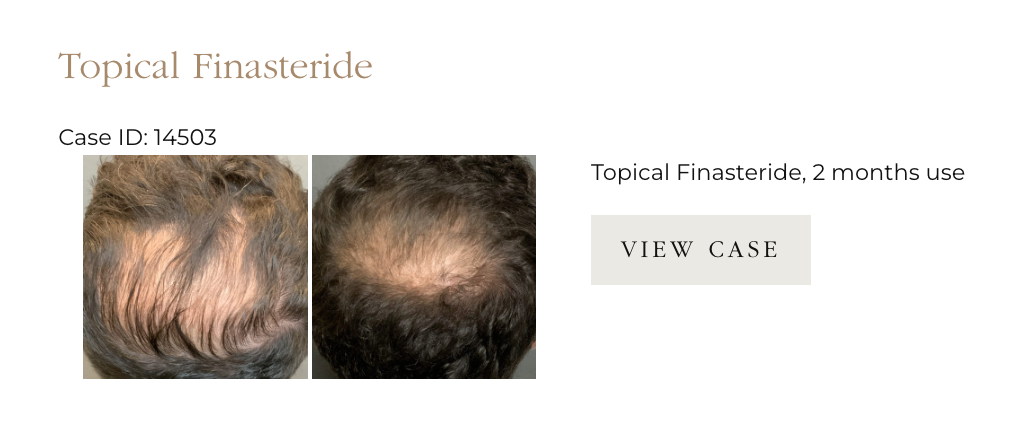 topical form of finasteride ufp hair restoration