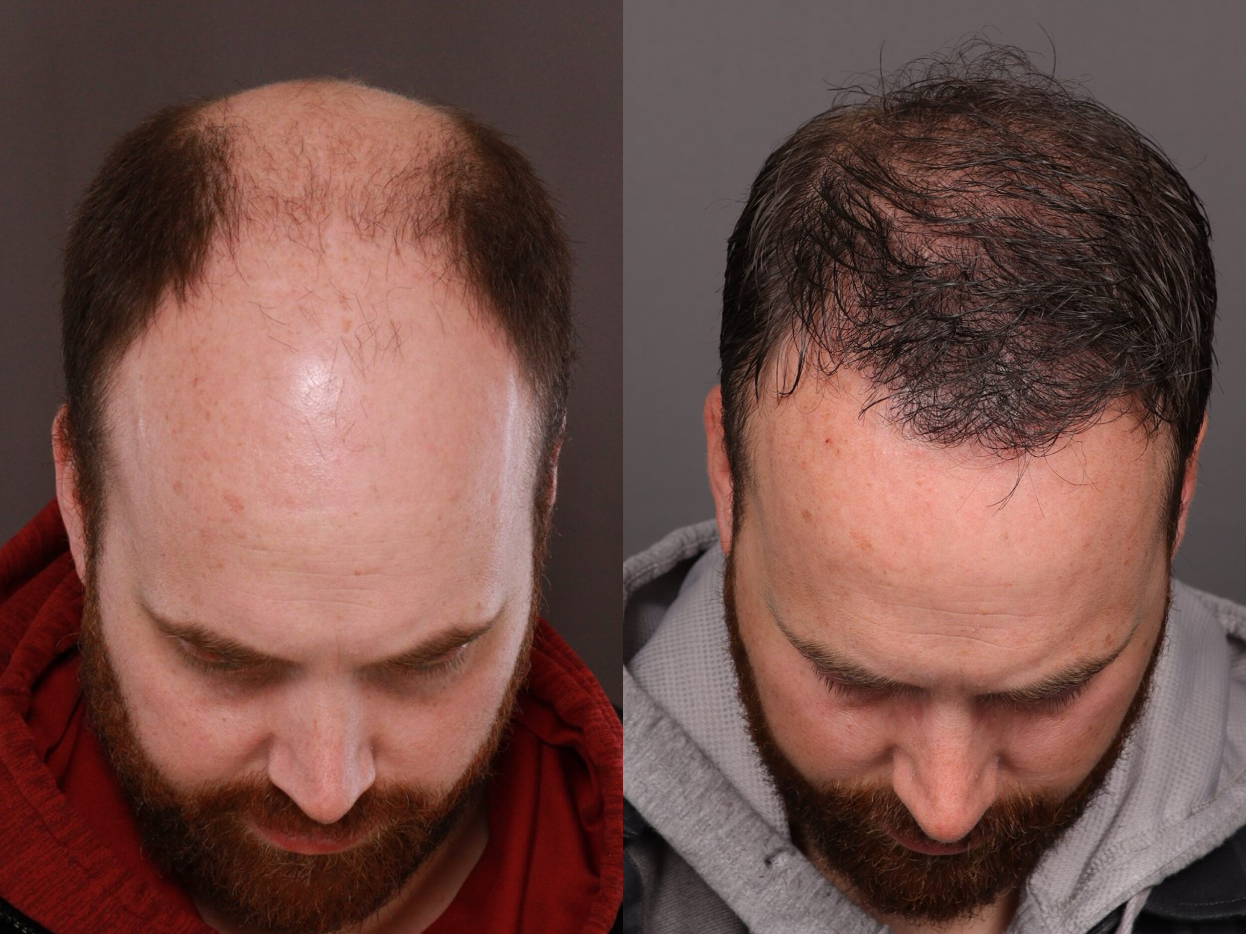 UFP Hair Restoration UFP Hair Restoration
