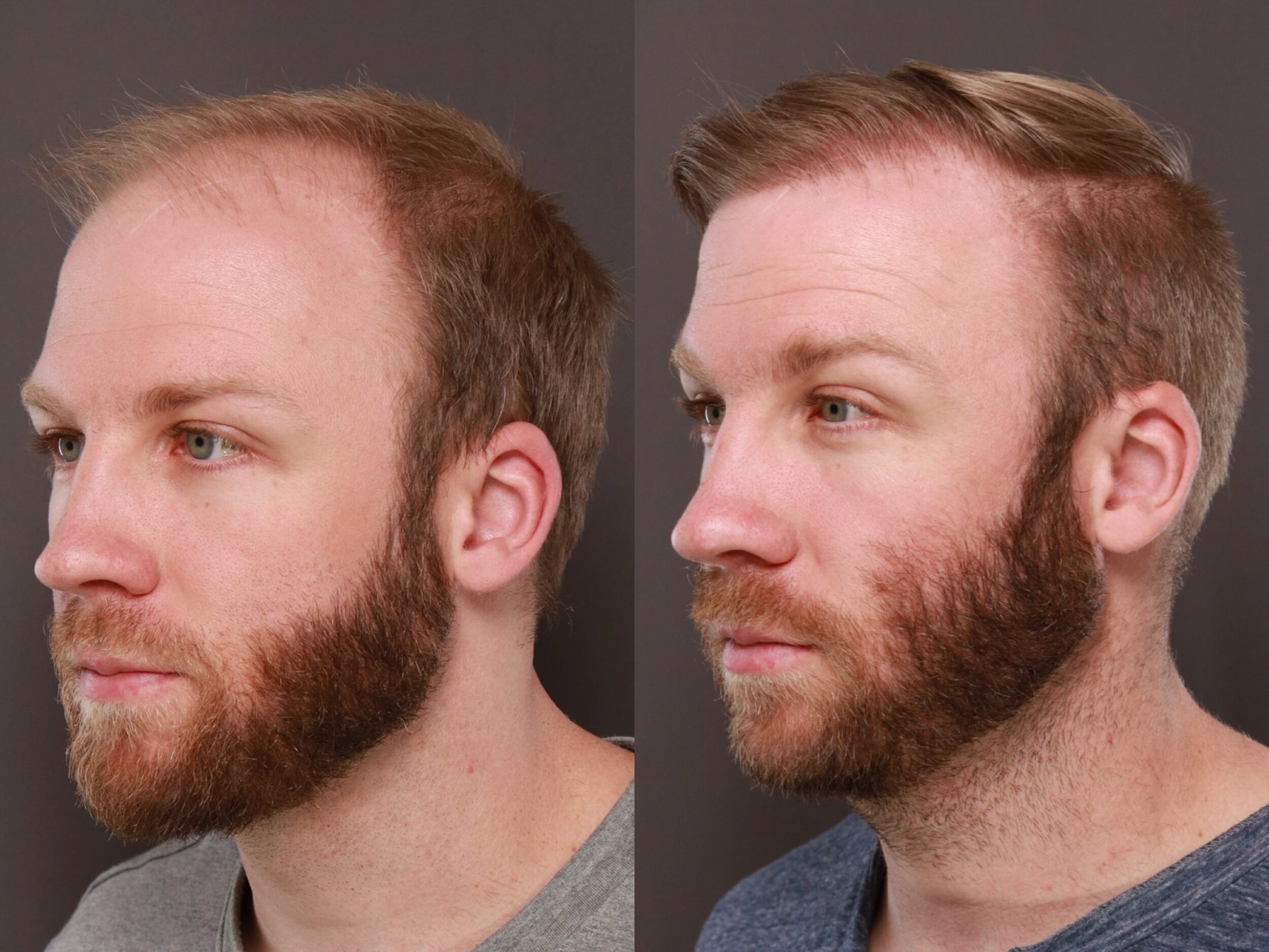 UFP Hair Restoration UFP Hair Restoration