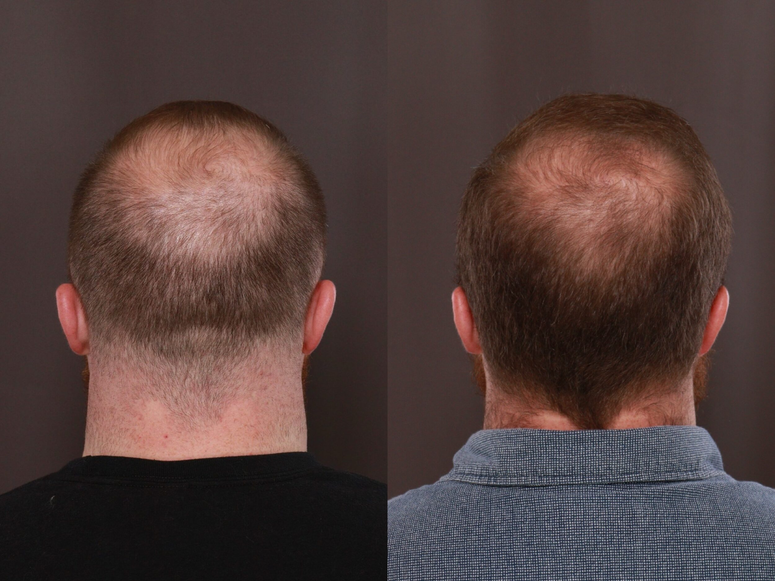 UFP Hair Restoration UFP Hair Restoration