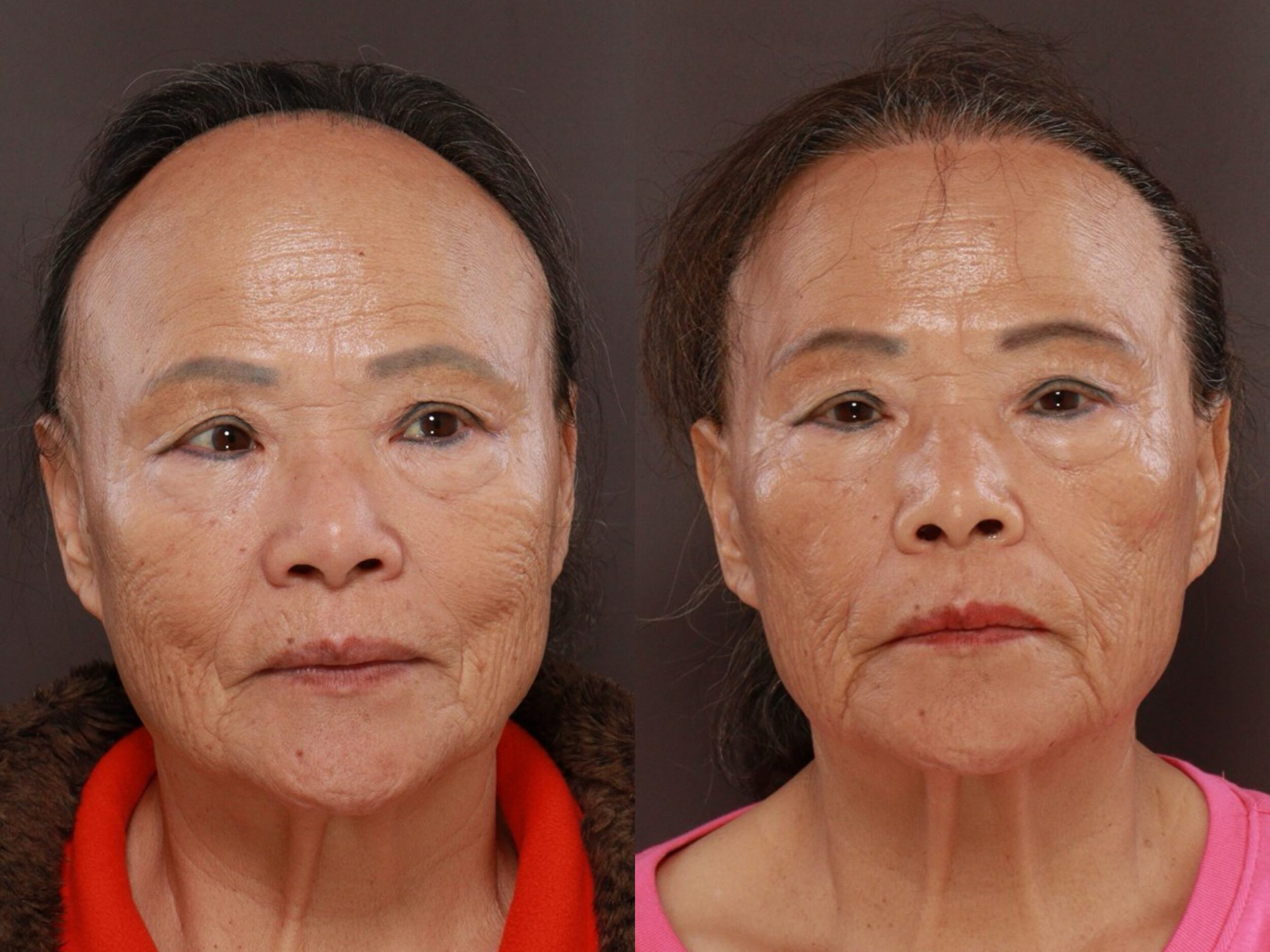 UFP Hair Restoration UFP Hair Restoration
