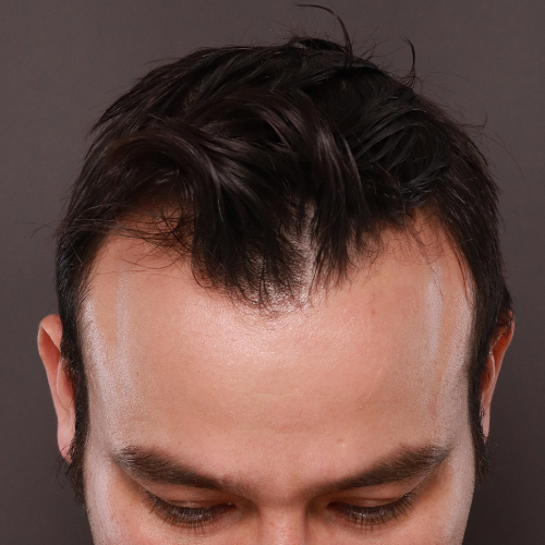 Before Image: FUE Hair Transplant, 1400 grafts - front