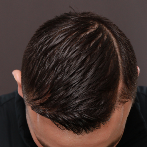 After Image: FUE Hair Transplant, 1400 grafts - front
