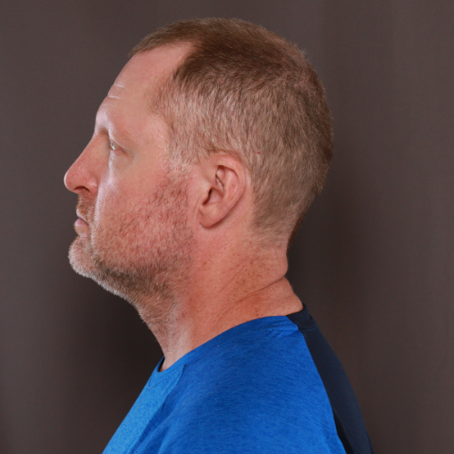 Before Image: Eyebrow Transplant by Dr. Manning - left-side