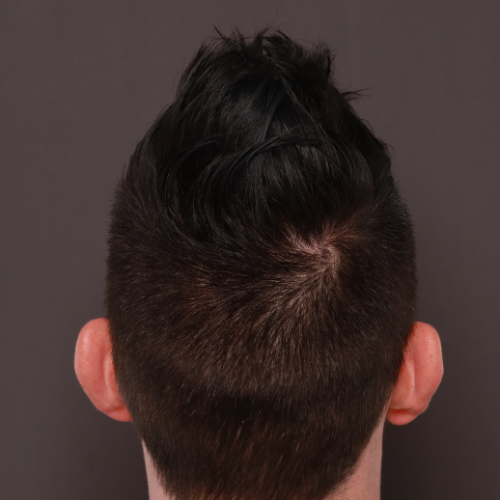 Before Image: FUE Hair Transplant 1000 Grafts - back
