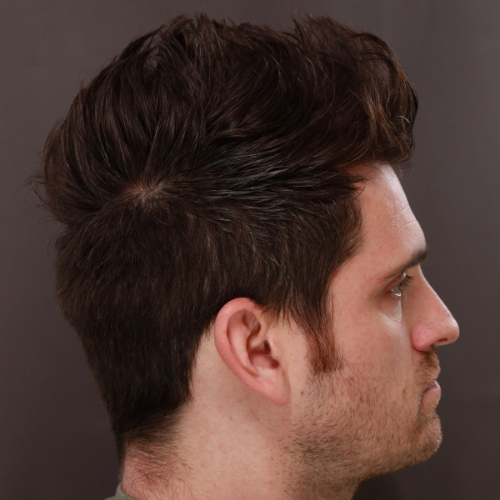 After Image: FUE Hair Transplant 1000 Grafts - right-side