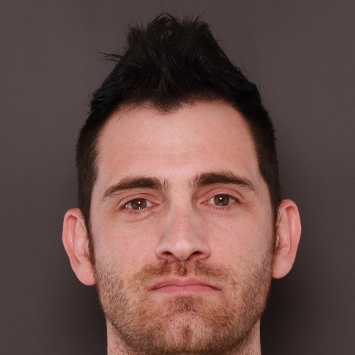 Before Image: FUE Hair Transplant 1000 Grafts - front