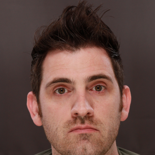 After Image: FUE Hair Transplant 1000 Grafts - front
